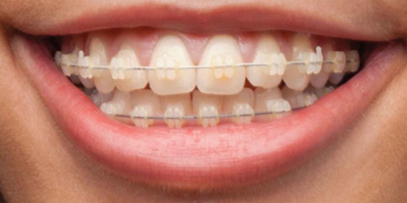 invisible braces vs invisalign